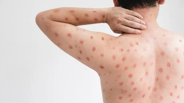 Pierwszy przypadek małpiej ospy w Polsce – co musisz wiedzieć?